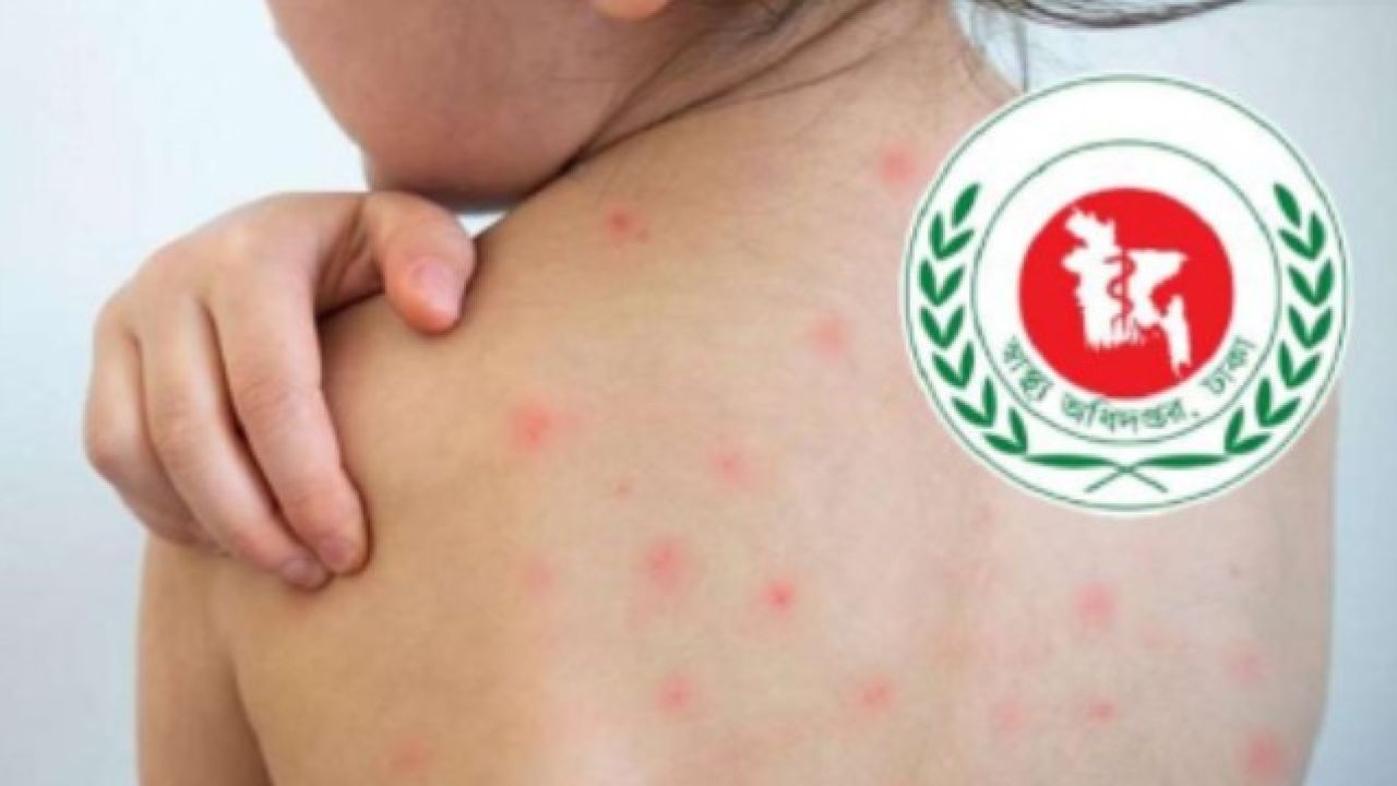 হামে আরও ৫ শিশুর মৃত্যু, একদিনে আক্রান্ত ১৪১১